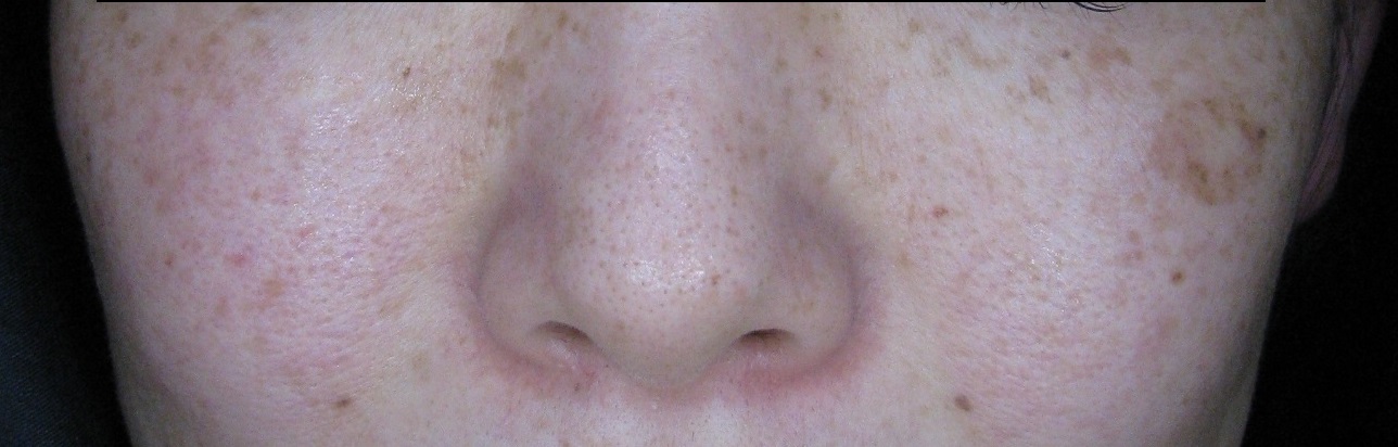 鼻の赤みのサイン 広島 エステサロン Calmia カルミア スタッフブログ